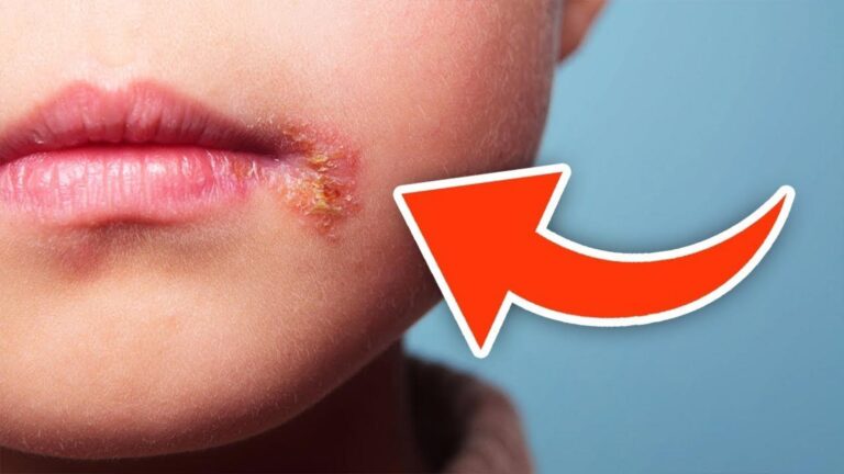 Questo semplice gesto elimina l’herpes e trasforma la tua pelle…